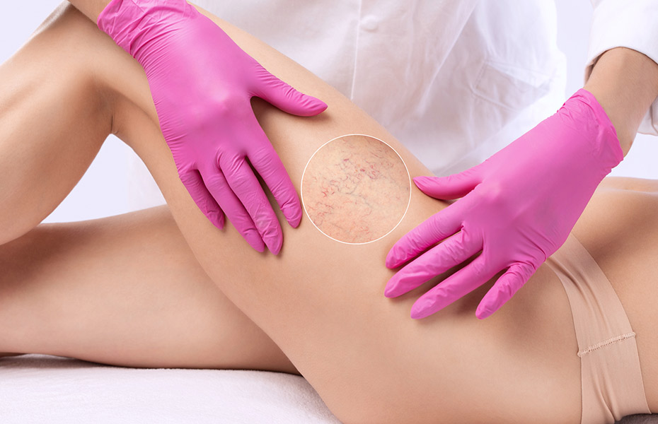 sklero 1, 1, Склеротерапия: современный и эффективный метод удаления вен склеротерапия